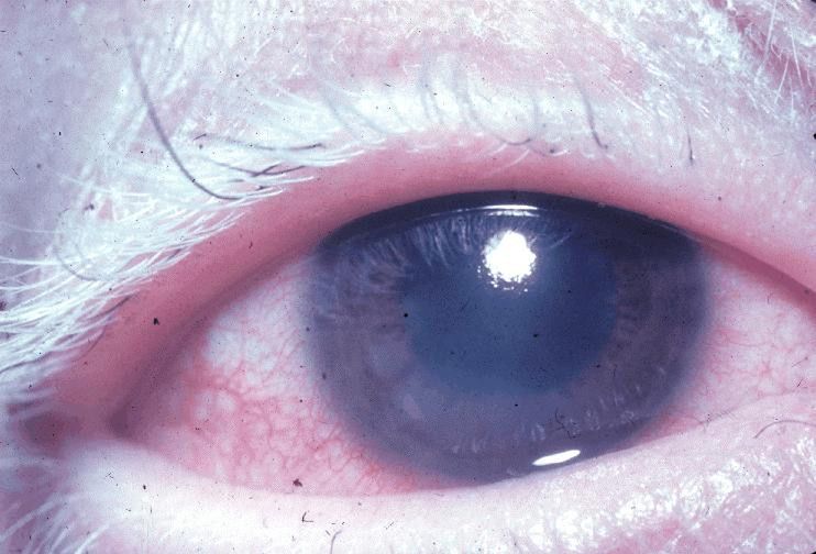 Choroby oczu - objawy zapalenia błony naczyniowej 