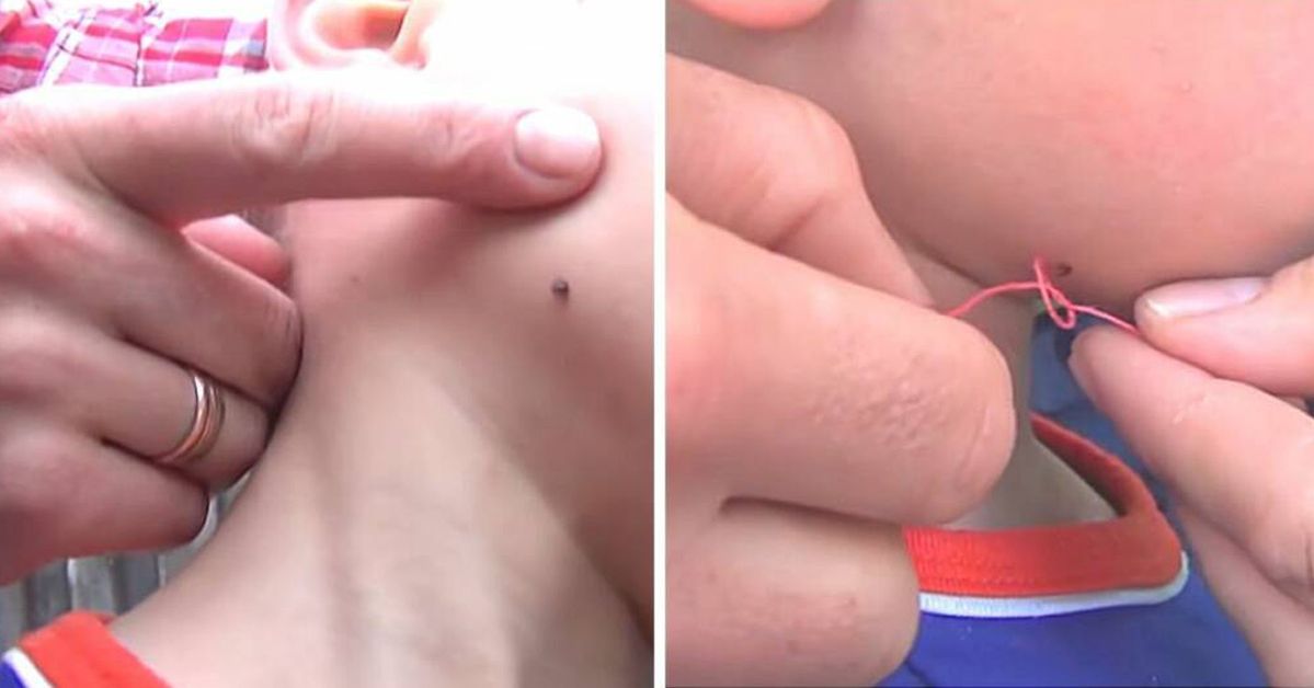 3 Safe Ways to Remove a Tick without Tweezers. They Will Work Anywhere!