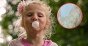 Połykanie gumy do żucia szkodzi? To zdjęcie ze szpitala mówi samo za siebie