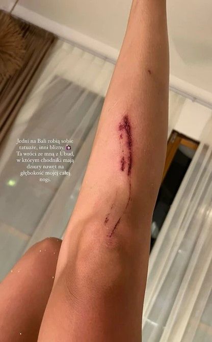 Izabella Krzan miała wypadek na Bali. Zdjęcie