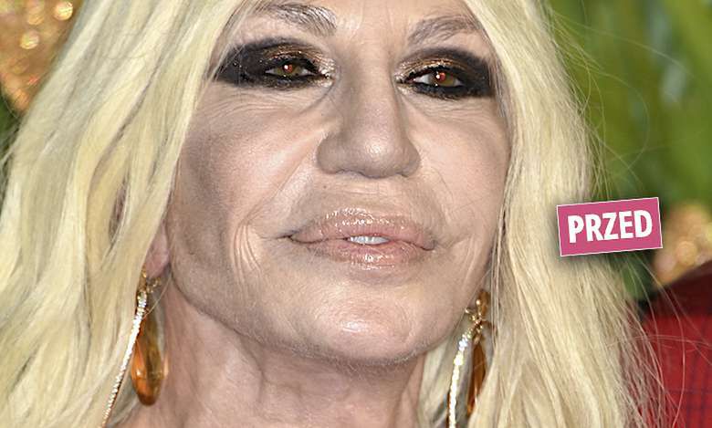 Donatella Versace "zmieniła" twarz! Po operacji odmłodniała o 20 lat! Cały świat zachwyca się tym, jak cudnie wygląda!