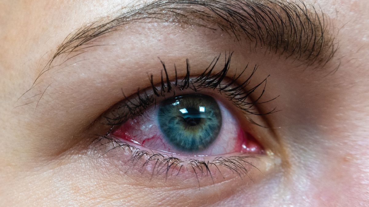 Zapalenie spojówek może być oznaką COVID-19