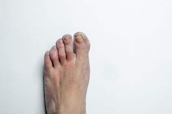 Żółte paznokcie u nóg to nie tylko problem estetyczny, ale w wielu przypadkach również objaw zakażenia grzybiczego.