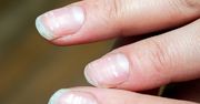 Zauważyłeś na paznokciach? Sygnał alarmowy
