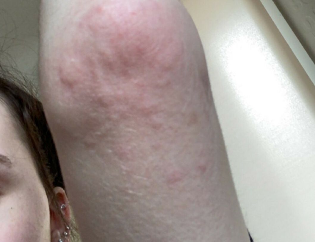 Sophie doznała bolesnej wysypki