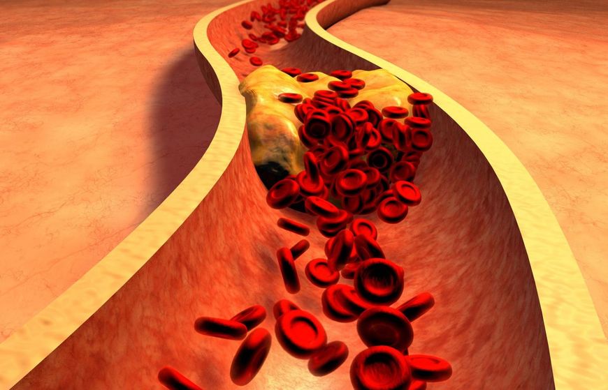 Wysoki cholesterol