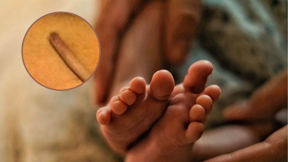 Urodził się z ogonem. Jest jednym z 40. udokumentowanych noworodków