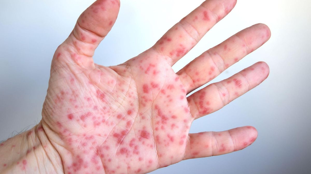 Jednym z objawów kiły jest wysypka przypominająca plamy na skórze.