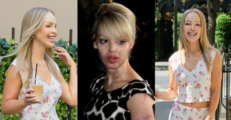 Została OBLANA KWASEM i przeszła 400 operacji. Tak dziś wygląda Katie Piper (ZDJĘCIA)