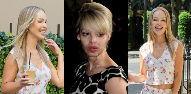 Została OBLANA KWASEM i przeszła 400 operacji. Tak dziś wygląda Katie Piper (ZDJĘCIA)