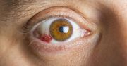 Pęknięte naczynka w oku. Sprawdź przyczynę problemu