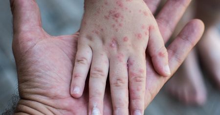Nietypowa choroba atakuje dzieci. Już ponad 80 przypadków
