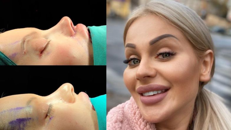 Ewelona zoperowała sobie nos