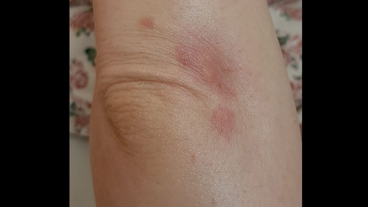 Zmiany skórne po COVID-19