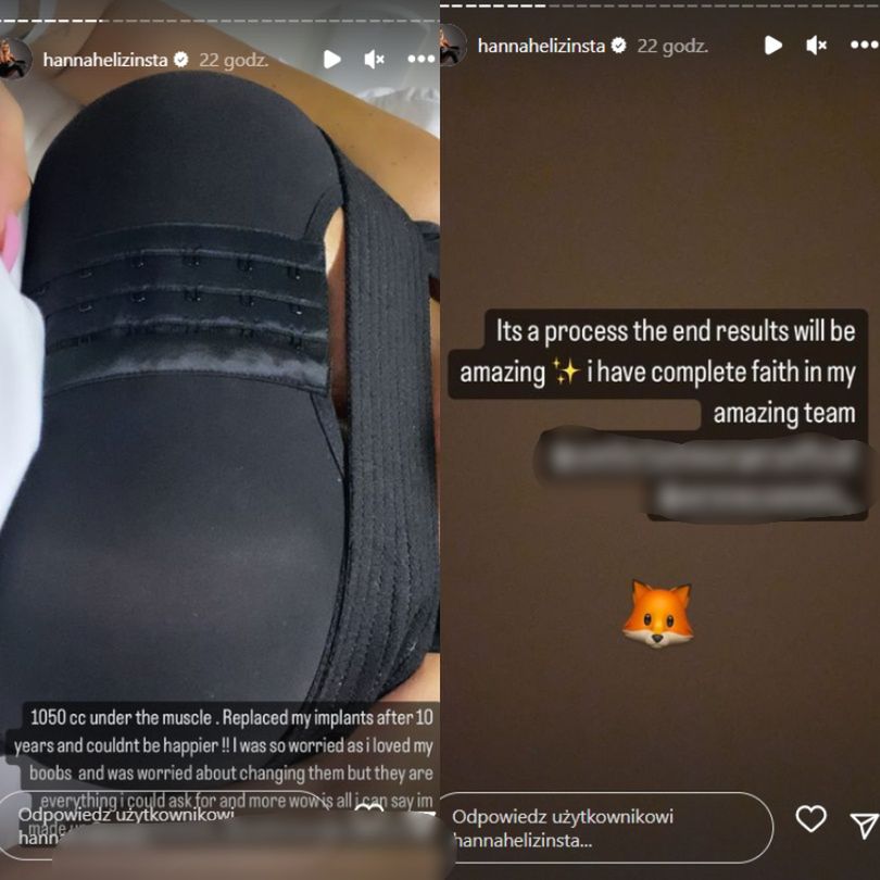 Uczestniczka brytyjskiego "Love Island" chwali się efektami operacji w tureckiej klinice