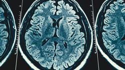 Zdiagnozowano u niego chorobę Alzheimera. Ma zaledwie 19 lat
