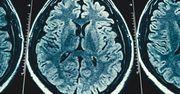 Zdiagnozowano u niego chorobę Alzheimera. Ma zaledwie 19 lat