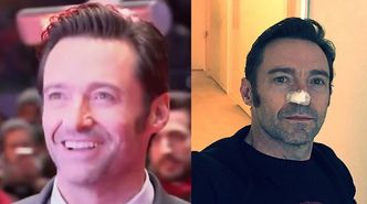 Hugh Jackman o raku skóry: "Jest dobrze. Wszytko naprawione i wycięte"