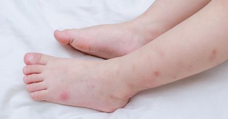 Alergia na jad meszek może prowadzić nawet do śmierci. Niebezpieczne dla niemowląt