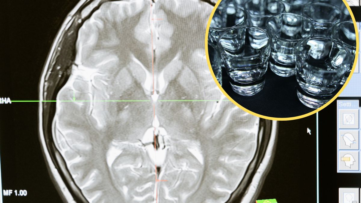 Naukowcy udowadniają, że alkohol może mieć wpływ na stan zapalny w naszym mózgu
