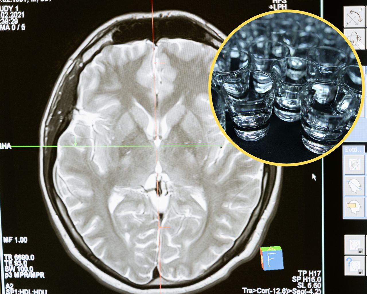 Scientists prove that alcohol can affect inflammation in our brain.