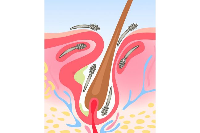 Gruczoły łojowe w skórze wytwarzają zbyt dużo łoju, przez co zatykają się pory skóry