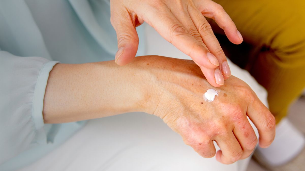 Pomarańczowe plamy na dłoniach mogą być wynikiem reakcji alergicznej