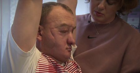 10 lat temu przeszczepiono mu nową twarz. „Dostałem nowe życie”