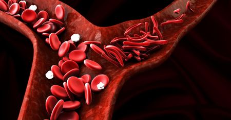 Anemia sierpowata - wpływ na organizm, objawy