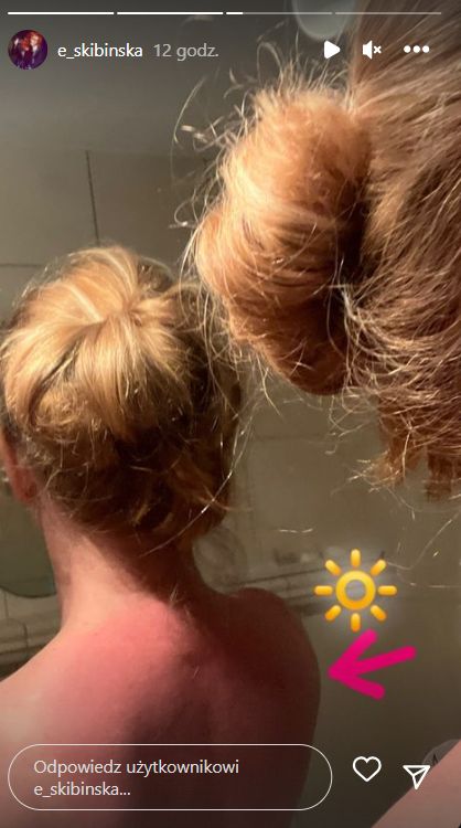 Ewa Skibińska zapozowała topless i pokazała, jak spiekła się na słońcu