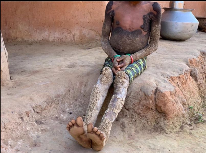 Choroba nie jest zaraźliwa