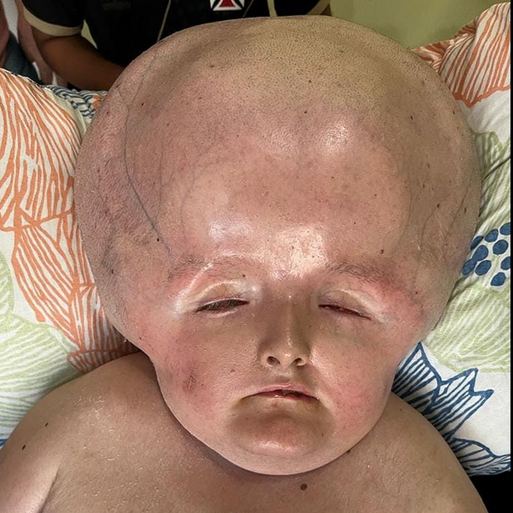 Gaziely ma wodogłowie