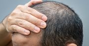 Tracą włosy, nie wiedząc o chorobie. "Sygnał, że w organizmie dzieje się coś poważniejszego"