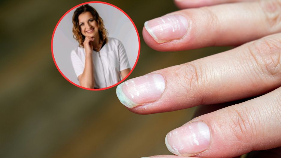 O czym świadczą linie Meesa na paznokciach?