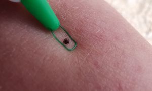 Wyciągnął tysiące kleszczy. Metoda weterynarza to absolutny hit