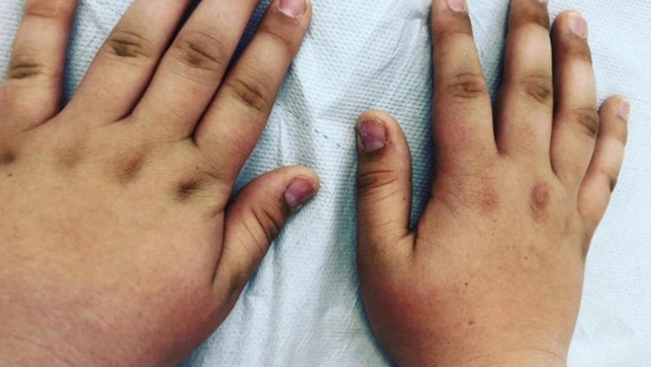 Nastolatka przez pół roku przytyła 12 kg. Lekarka zdradza powód