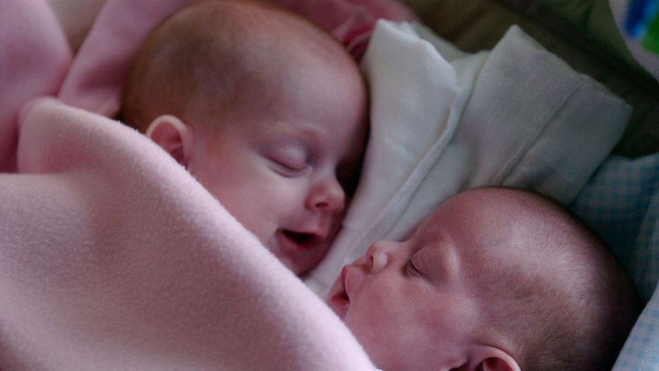 Isabelle i Abby Carlsen - bliźniaczki syjamskie