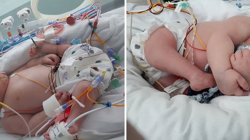 Mały Baron urodził z odwróconymi kończynami