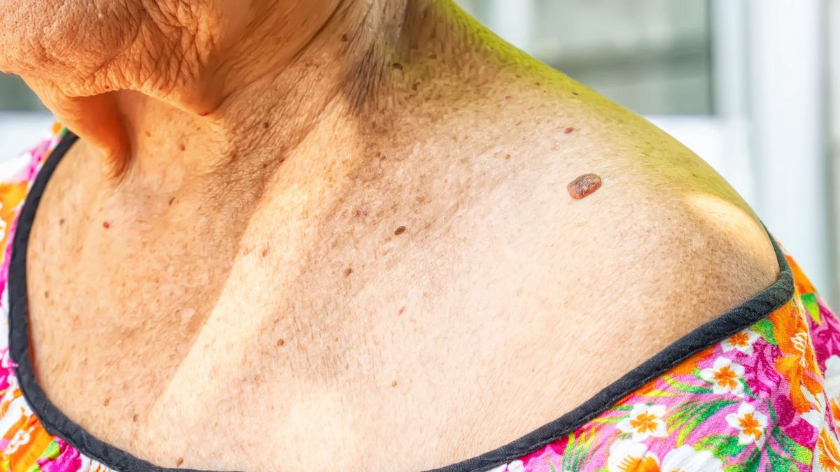 Dermatofibroma to zmiany skórne, które mogą pojawić się niemal wszędzie, choć mają swoje "ulubione" miejsca na ciele. 