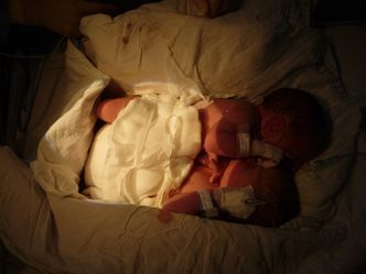 Bliźnięta syjamskie urodziły się w Warszawie