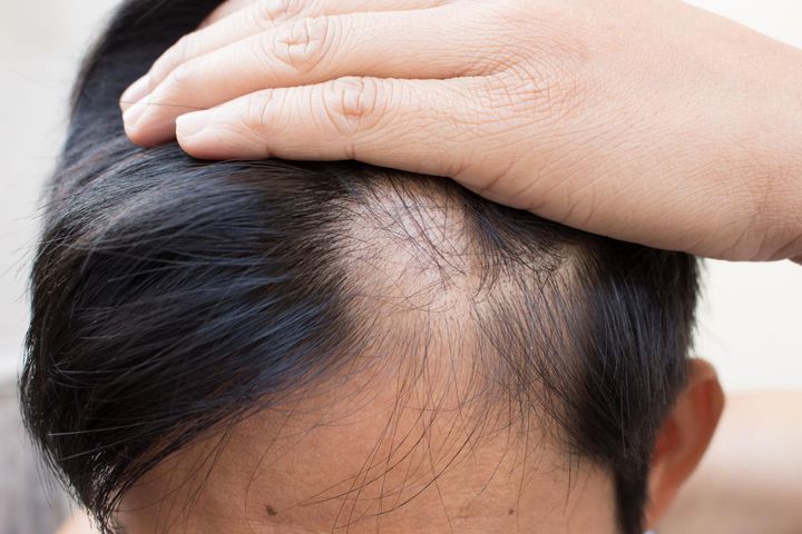 Problem łysienia plackowatego często dotyczy ludzi młodych