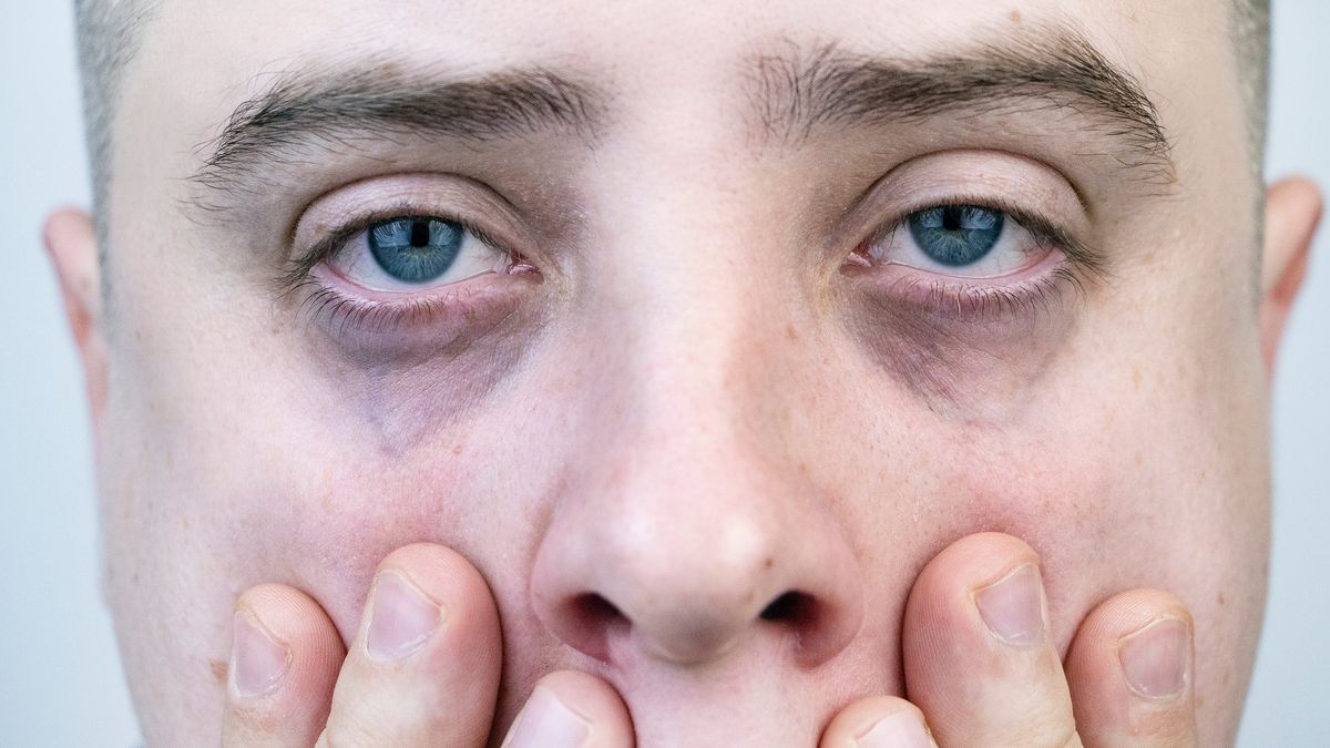 Podkrążone oczy mogą ostrzegać o chorym sercu