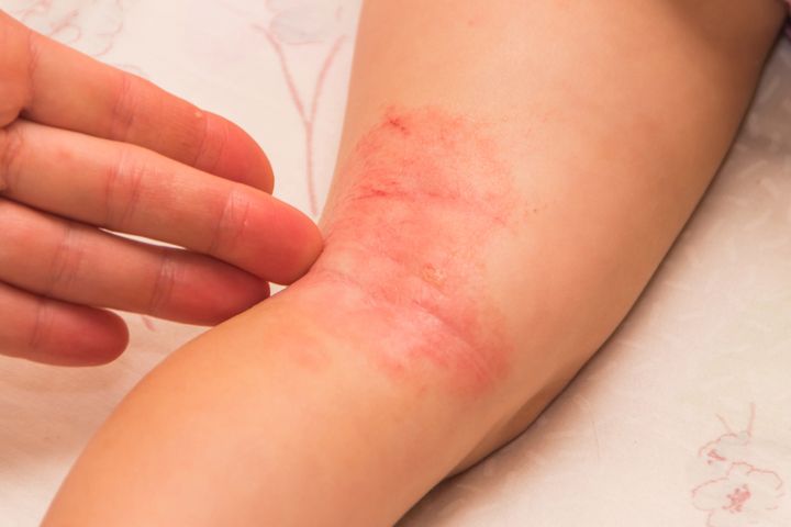 U dzieci z grzybicą znacznie częściej rozwiją się reakcje alergiczne.