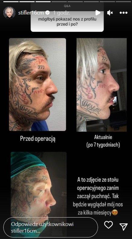Stifler pokazał twarz po operacjach plastycznych