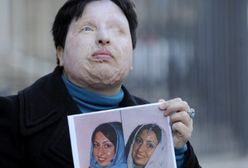 Oblał ją kwasem, a ona mu wybaczyła