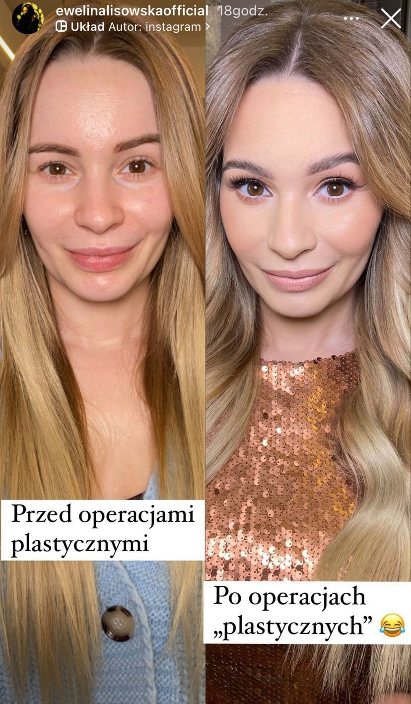 Ewelina Lisowska przed i po operacjach