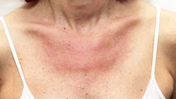 Objaw pojawia się na skórze. To znak, ze trzustka woła o pomoc