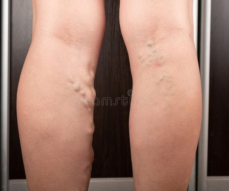 Zakrzepica – choroba, która może dopaść każdego