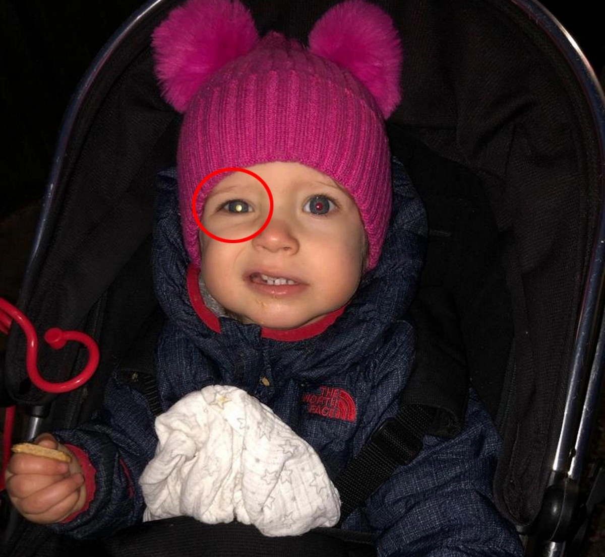 Mam dostrzegła zmianę na oku, tak dawał o sobie znać groźny nowotwór