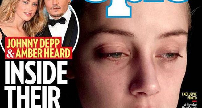 Amber Heard pokazuje siniaki w magazynie "People"